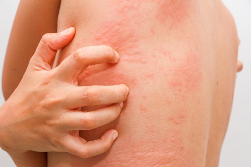 Cold urticaria is a condition where one is allergic to the cold weather; it is estimated to affect 1% to 3% of all sufferers 