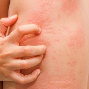 Remibrutinib shows potential in chronic spontaneous urticaria