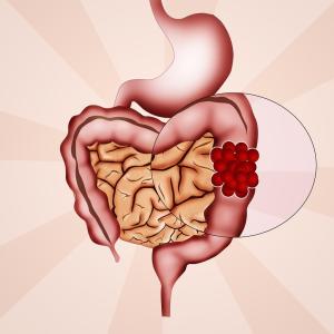 Serum D-dimer not predictive of colon polyp size, pathology