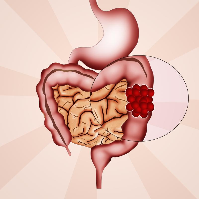 Colon cancer survival with neoadjuvant chemo vs upfront surgery a toss-up