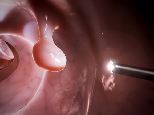 AI fails to improve colonoscopic detection of advanced neoplasias