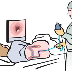 Screening colonoscopy helps reduce CRC incidence, death