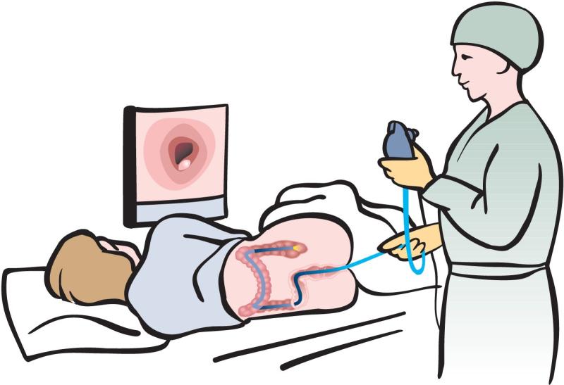 Screening colonoscopy helps reduce CRC incidence, death