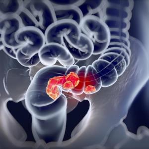 Onvansertib plus chemo shows promise in KRAS-mutant metastatic colorectal cancer