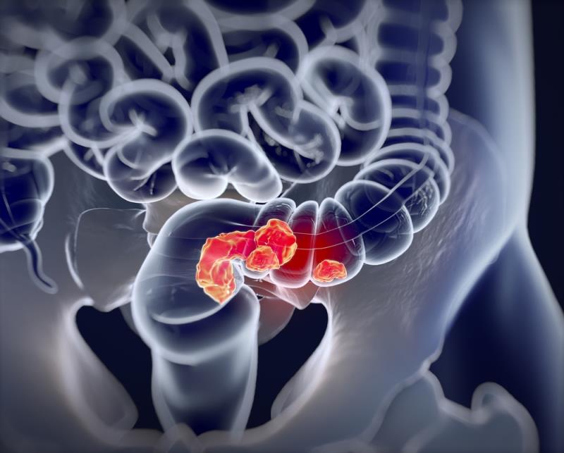 Onvansertib plus chemo shows promise in KRAS-mutant metastatic colorectal cancer