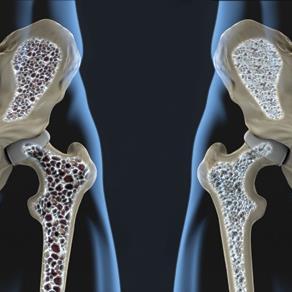 BMD, TBS higher in elderly hip fracture patients with vs without T2DM