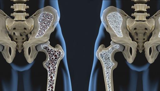 BMD, TBS higher in elderly hip fracture patients with vs without T2DM