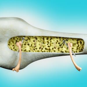 Goserelin-induced menstrual cessation promotes bone loss