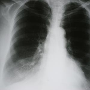 Osimertinib plus selumetinib shows promise in advanced NSCLC