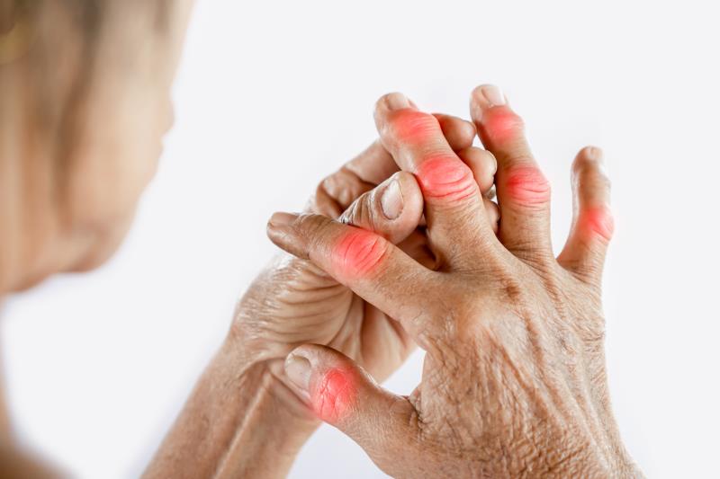 COSMOS: Guselkumab improves response rates in active psoriatic arthritis