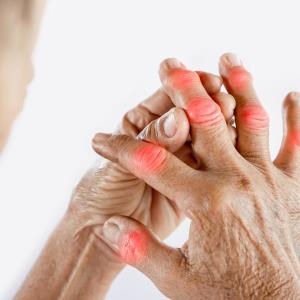 COSMOS: Guselkumab improves response rates in active psoriatic arthritis