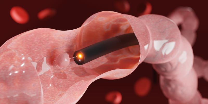 Could a single screening colonoscopy prevent CRC?