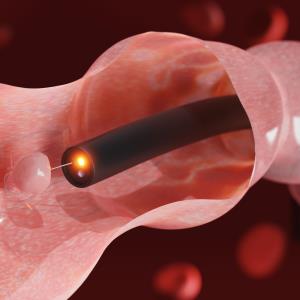 Older age at first screening colonoscopy linked to higher risk of adenomas, CRC