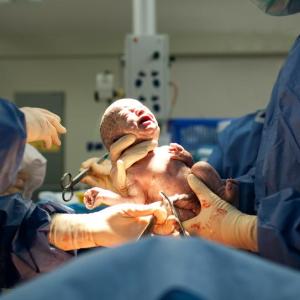 Early feeding after caesarean delivery does not increase gastrointestinal complaints