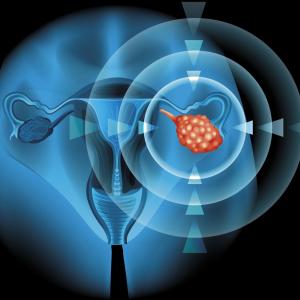 Prexasertib works in select patients with recurrent ovarian cancer