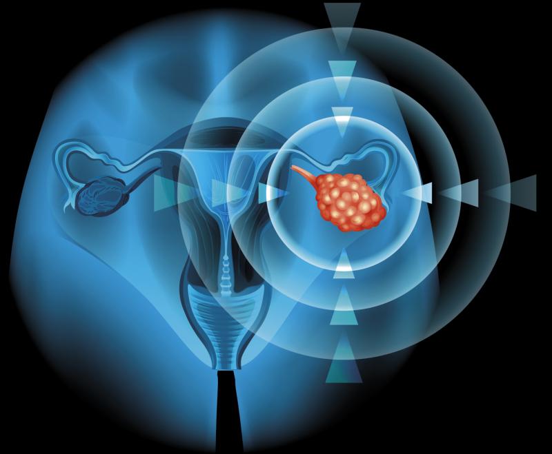 Prexasertib works in select patients with recurrent ovarian cancer