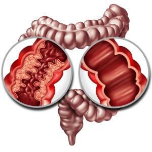 5-ASA maintenance therapy of little help in patients with newly diagnosed CD