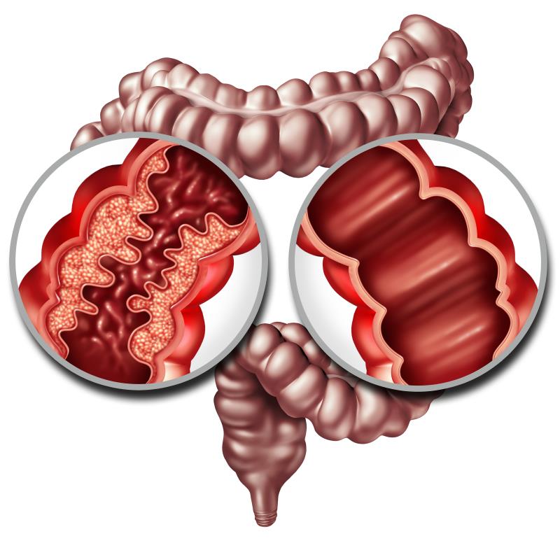 Triple drug combo induces endoscopic remission in more than a third of CD patients