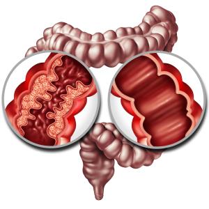 Vedolizumab after resection helps prevent CD recurrence