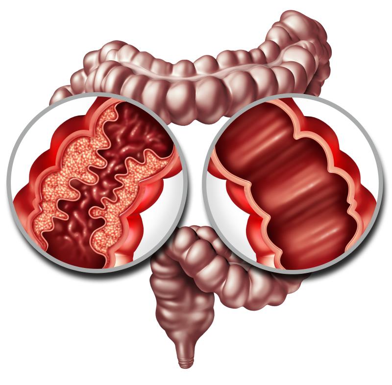 Vedolizumab after resection helps prevent CD recurrence