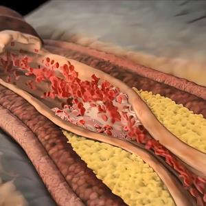 CT angiography may increase potential EVT recipients for acute ischaemic stroke