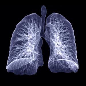 Lung function decline predicts death in fibrotic hypersensitivity pneumonitis