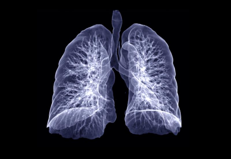 Lung function decline predicts death in fibrotic hypersensitivity pneumonitis