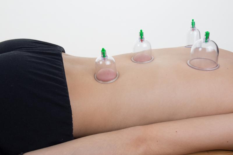 Cupping therapy offers relief from chronic pain