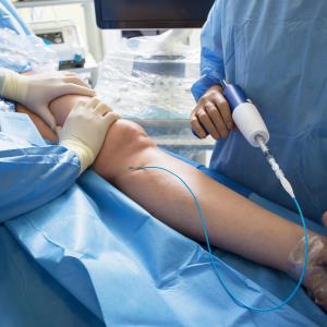 Cyanoacrylate endovenous closure device excels in Asians with varicose veins