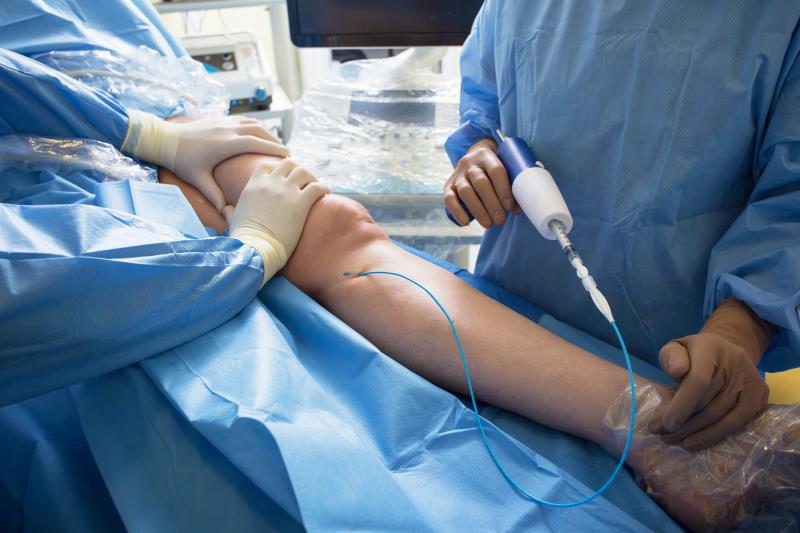 Cyanoacrylate endovenous closure device excels in Asians with varicose veins