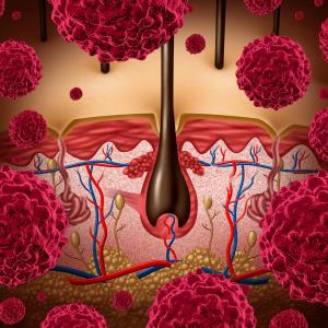 Camrelizumab plus apatinib and temozolomide delivers in advanced acral melanoma