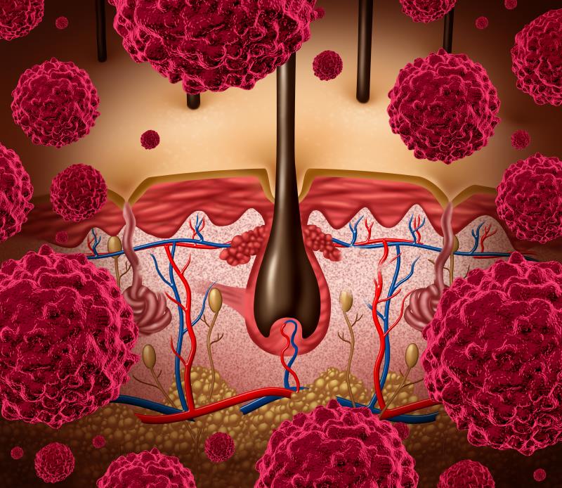 Camrelizumab plus apatinib and temozolomide delivers in advanced acral melanoma