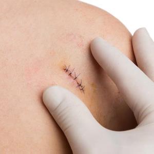 Daromun plus surgery improves survival in resectable melanoma