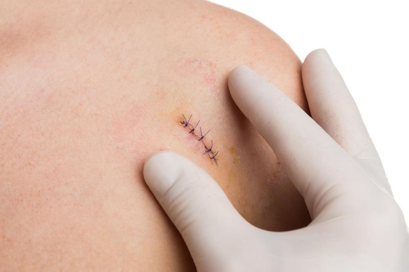 Daromun plus surgery improves survival in patients with resectable melanoma