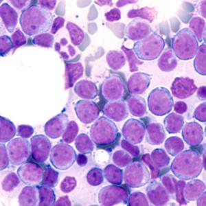 Daunorubicin for newly diagnosed AML: Does more equate to better outcomes?