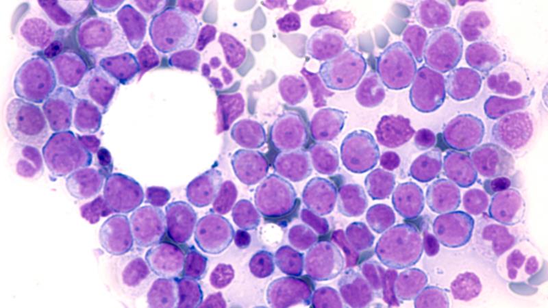 Daunorubicin for newly diagnosed AML: Does more equate to better outcomes?