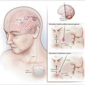 Adaptive vs conventional deep-brain stimulation offers advantages for Parkinson’s disease