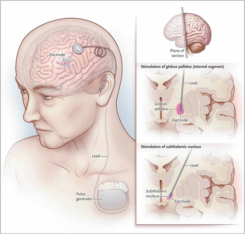 Adaptive vs conventional deep-brain stimulation offers advantages for Parkinson’s disease