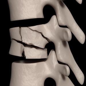 Delayed denosumab treatment may up vertebral fracture risk