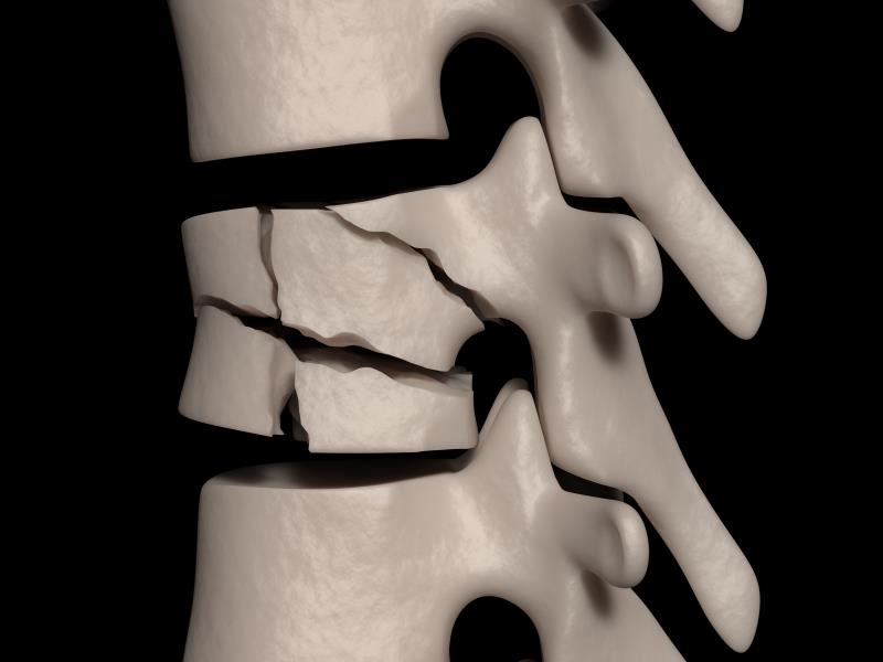 Delayed denosumab treatment may up vertebral fracture risk