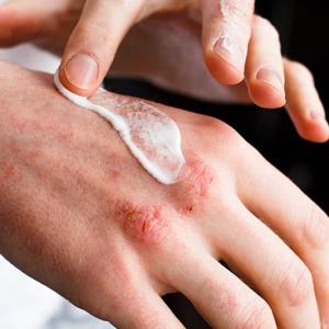 Delgocitinib cream a win for adults with chronic hand eczema