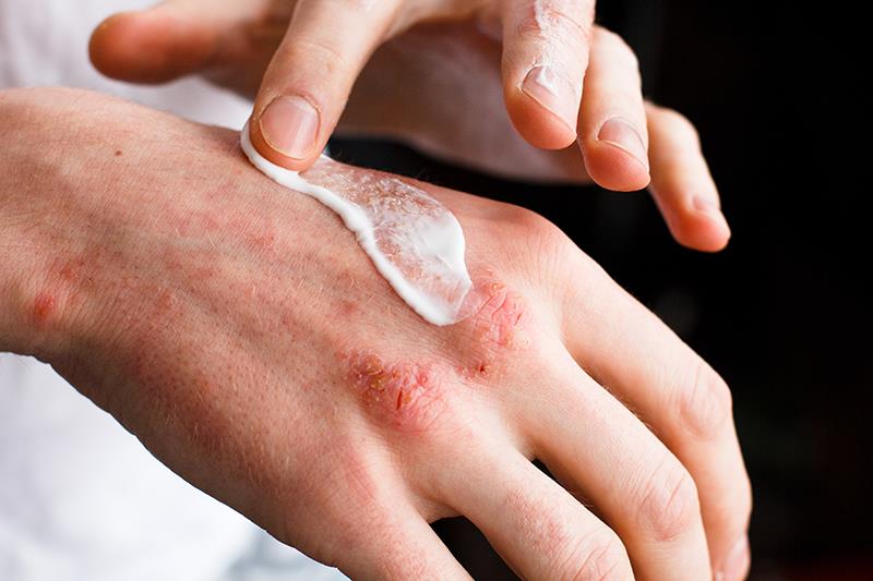 Delgocitinib cream a win for adults with chronic hand eczema