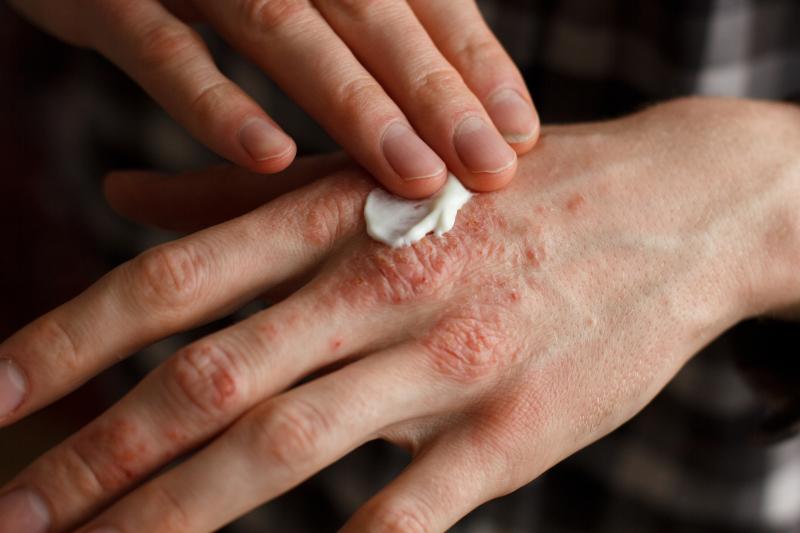 Delgocitinib ointment beneficial in chronic hand eczema