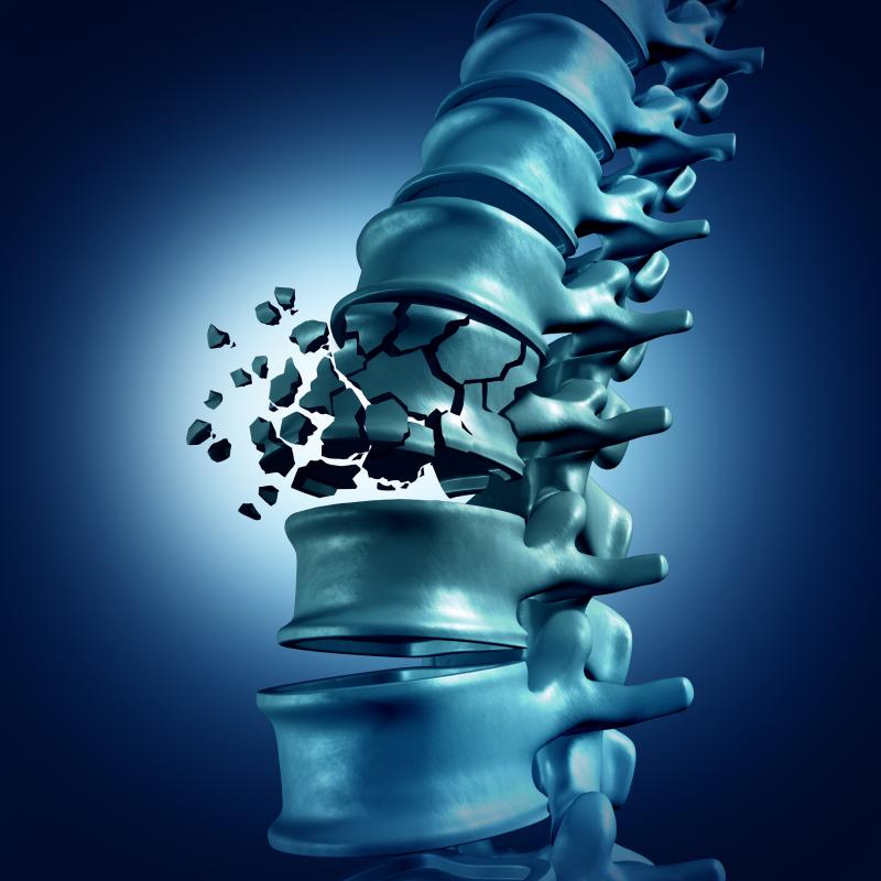 Delayed denosumab injections up fracture risk in osteoporotic patients