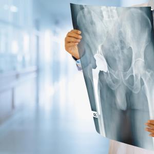 Denosumab may reduce need for revision hip arthroplasty due to osteolysis