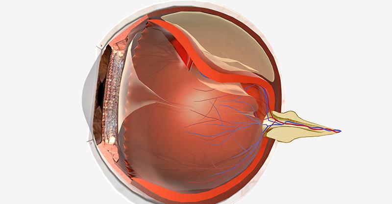 Densiron improves visual outcomes in eyes with primary RRD
