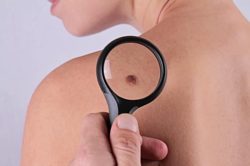 Skin cancer is among the top 10 cancers for men and women in Singapore