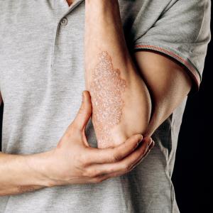 Ustekinumab safe, effective in Asians with moderate to severe plaque psoriasis