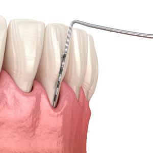 Diabetes-related complications tied to higher risk of periodontitis