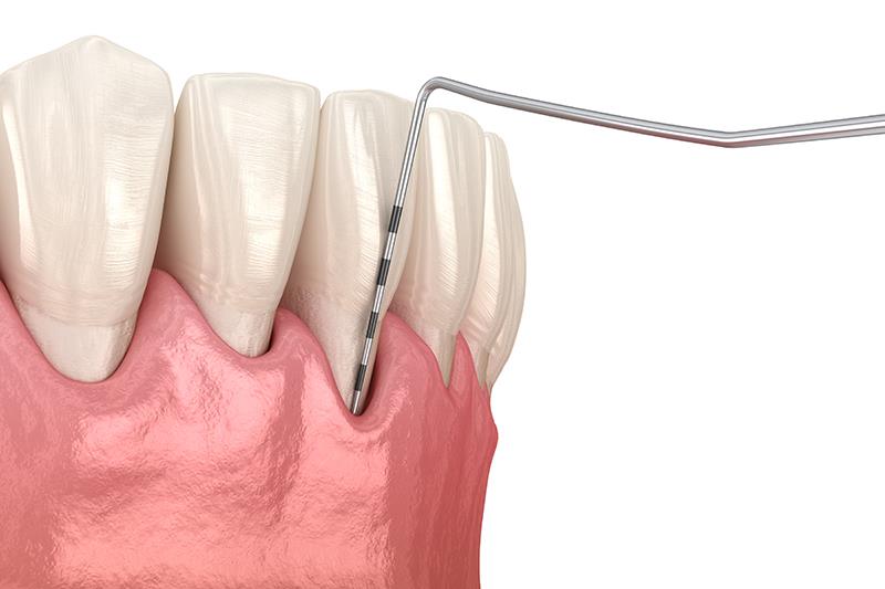 Diabetes-related complications tied to higher risk of periodontitis